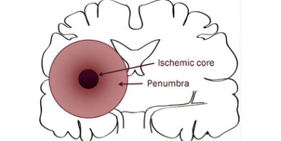 A drawing of a brain, highlighting ischemic core and penumbra.
