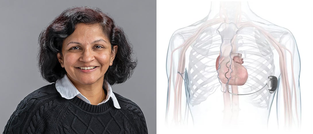 Dr. Sunita Ferns and EV-ICD illustration provided by Medtronic